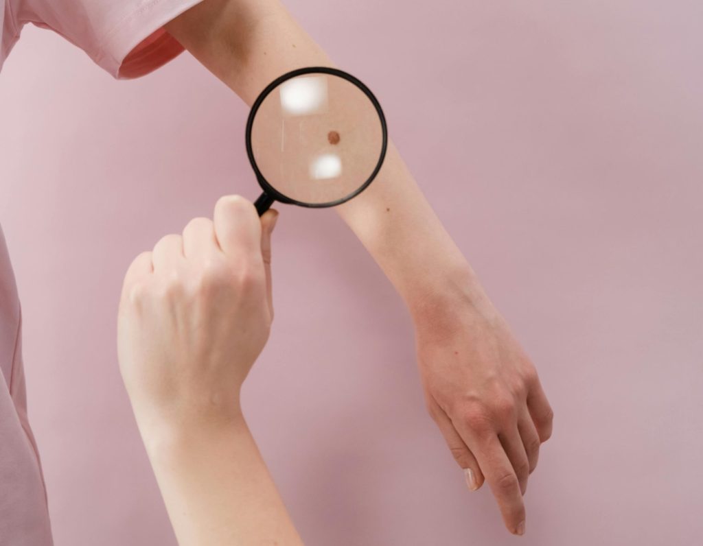 anyajegy eltávolítás