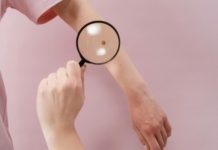 Az anyajegy eltávolítás fontossága anyajegy eltávolítás