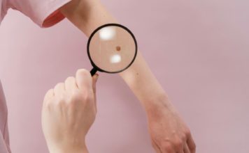 Az anyajegy eltávolítás fontossága anyajegy eltávolítás